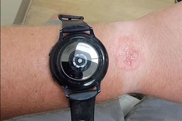 Bỏng cổ tay vì đeo Samsung Galaxy Watch qua đêm